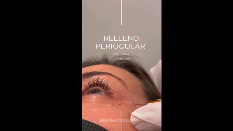 Relleno periocular - The CLINIQ
