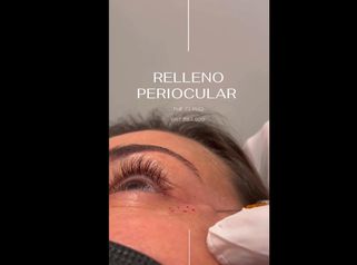 Relleno periocular - The CLINIQ
