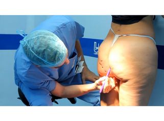 Adiós a los hoyuelos con Cellfina en Instituto Médico Miramar