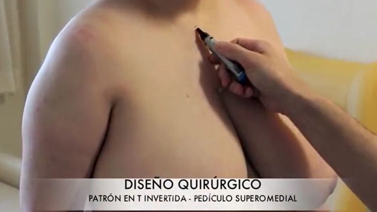 REDUCCIÓN DE PECHO - DR GUILARTE