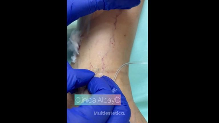 Tratamiento de varices - ClinicaAlbayC