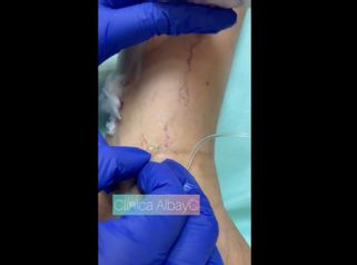 Tratamiento de varices - ClinicaAlbayC