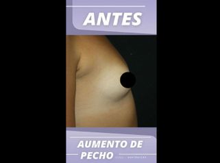 Aumento de pecho - Centro CEME