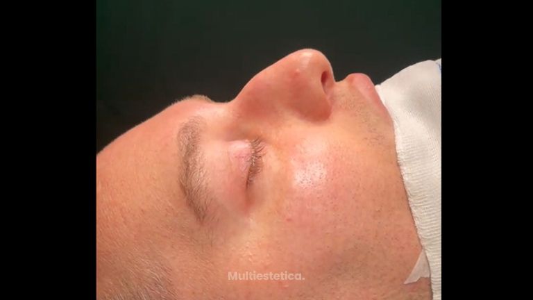 Rinoplastia - Dr. Pérez Villar