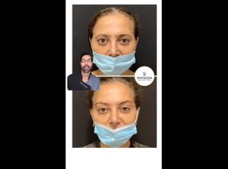 Lifting de cejas - Clínica Maysoon