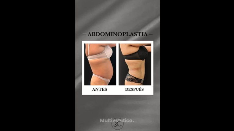 Abdominoplastia - Dr. Jose Casarrubios