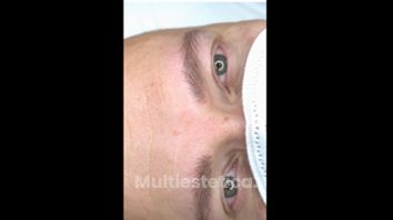 Microblading - Instituto Valenciano Micropigmentación