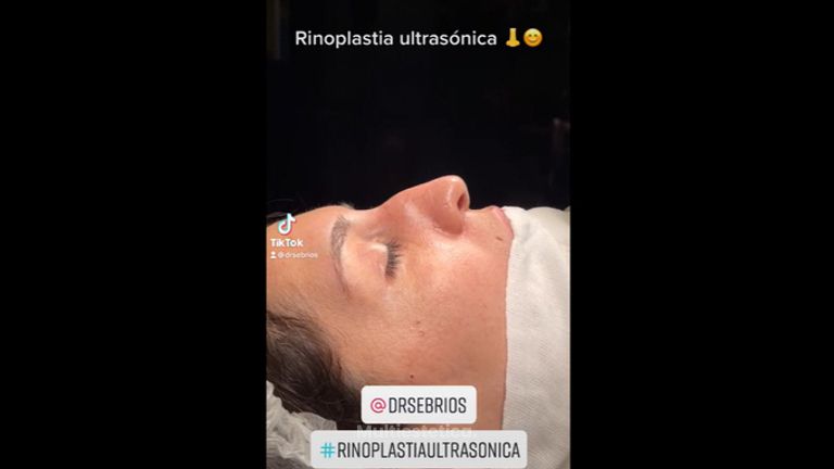 Rinoplastia - Dr. Sebastián Ríos