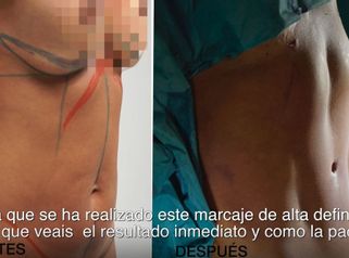 VaserLipo con la Dra. Pilar de Frutos