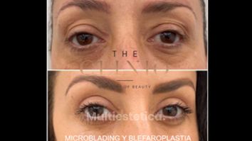 Microblading / Blefaroplastia - The CLINIQ