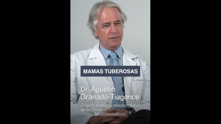 Mamas tuberosas - Clínica Granado Tiagonce