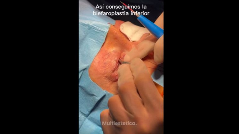 Blefaroplastia inferior - Dr. Jiménez Ortiz