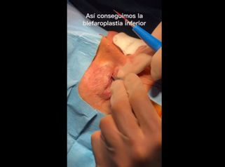 Blefaroplastia inferior - Dr. Jiménez Ortiz