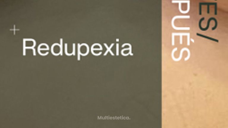 Resultados de mastopexia con reducción mamaria