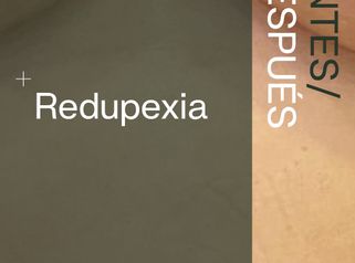 Resultados de mastopexia con reducción mamaria