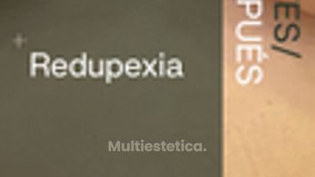 Resultados de mastopexia con reducción mamaria