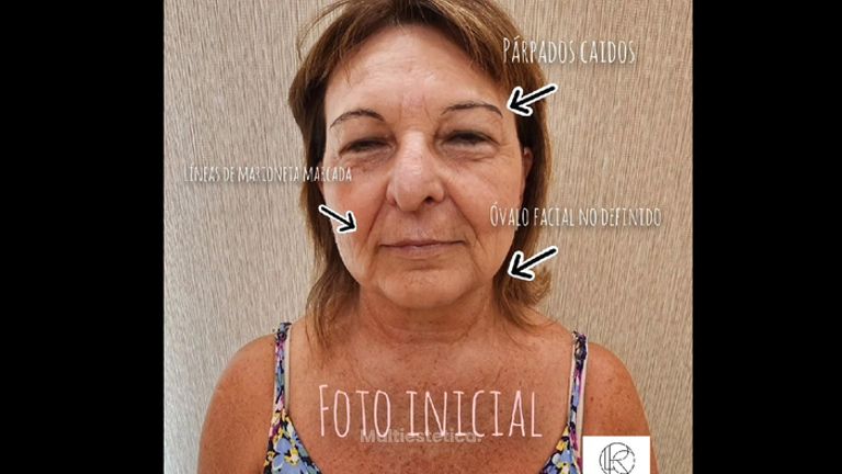 Full face - Les Rochas Clinic