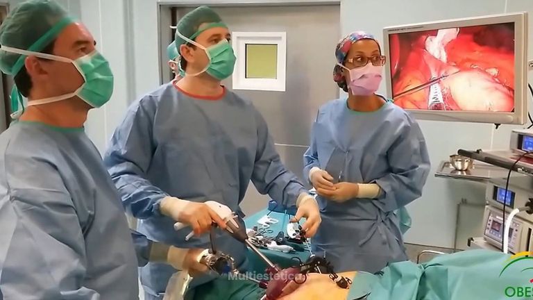 Reducción de estómago Tubo gástrico por laparoscopia a traves de una sola incisión
