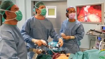 Reducción de estómago Tubo gástrico por laparoscopia a traves de una sola incisión
