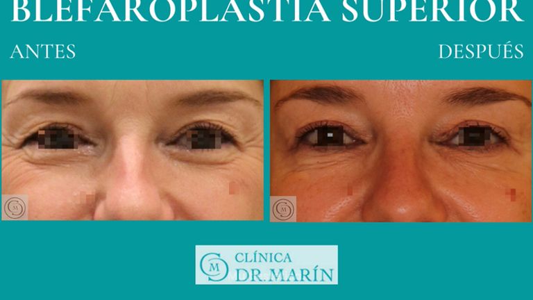 Blefaroplastia - Clínica Dr. Pascual Marín