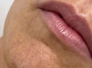 Clínica Carlos Gómez - Ácido hialurónico