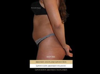 Liposucción - Ocean Clinic Madrid
