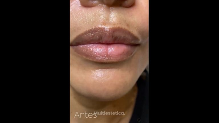 Aumento de labios - Clínica Graziella Moraes