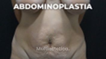 Abdominoplastia en quirófano - Clínica Opción Médica