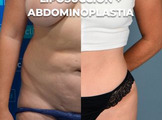 Cirugía combinada - Clínica Opción Médica