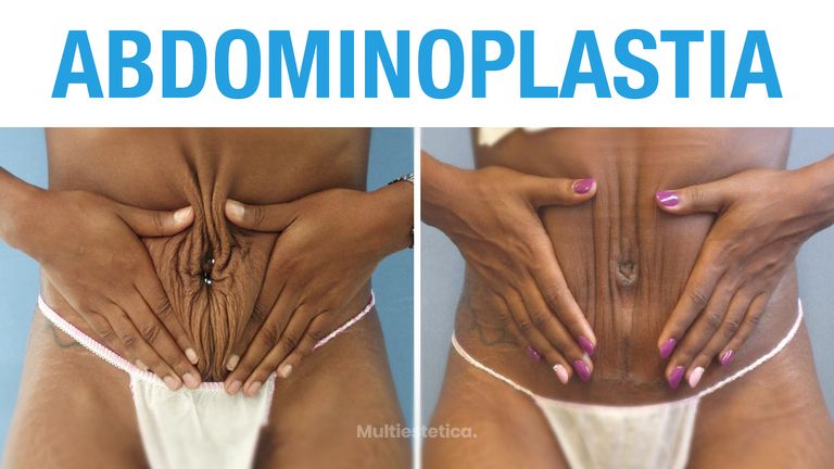 Antes y Después de Abdominoplastia
