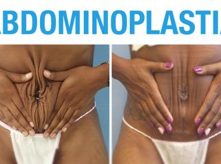 Antes y Después de Abdominoplastia