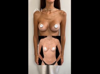 Aumento de pecho - Dr. Stefano Marcelli