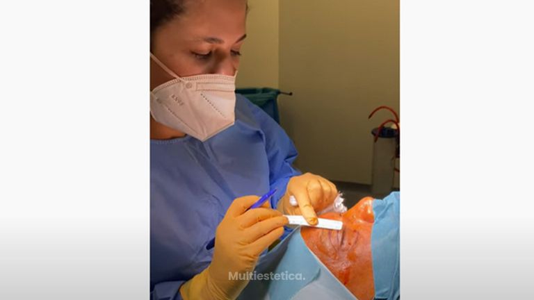 Blefaroplastia superior - Dra. Susan Díaz Reverand