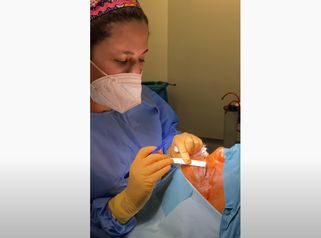 Blefaroplastia superior - Dra. Susan Díaz Reverand
