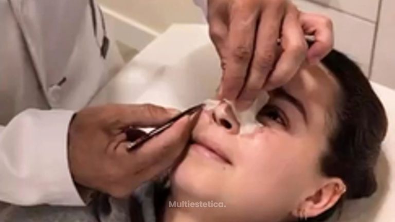 Una Rinoplastia poco común, tuvimos que hacer una reconstrucción del tabique.