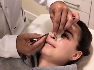 Una Rinoplastia poco común, tuvimos que hacer una reconstrucción del tabique.