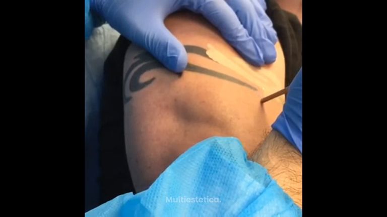 Eliminación de un tatuaje en directo