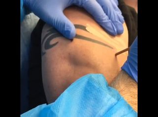 Eliminación de un tatuaje en directo