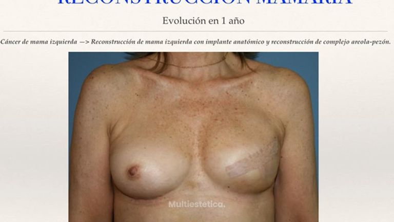 Reconstrucción de pecho  Mama  Cirujano Plástico  Madrid