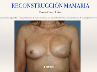 Reconstrucción de pecho  Mama  Cirujano Plástico  Madrid