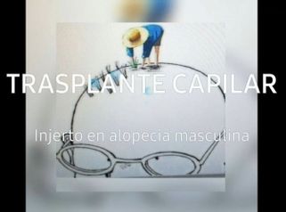 Trasplante Capilar - Doctora Barba Martínez