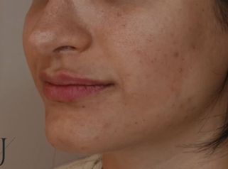 Aumento de labios - Clínica Alejandría