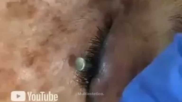 Clínica Delas - Eliminacion de tatuajes
