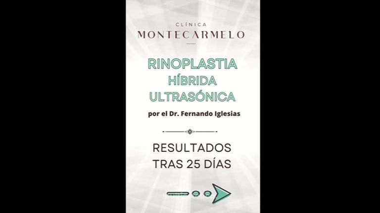 Rinoplastia - Clínica Montecarmelo