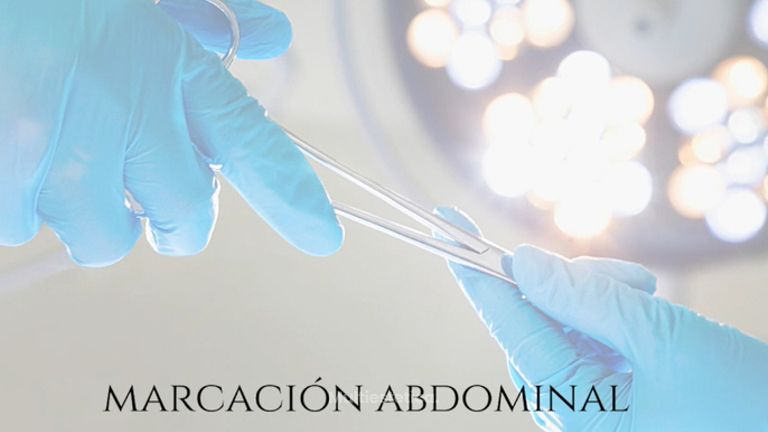Marcación abdominal - Dr. Quintero
