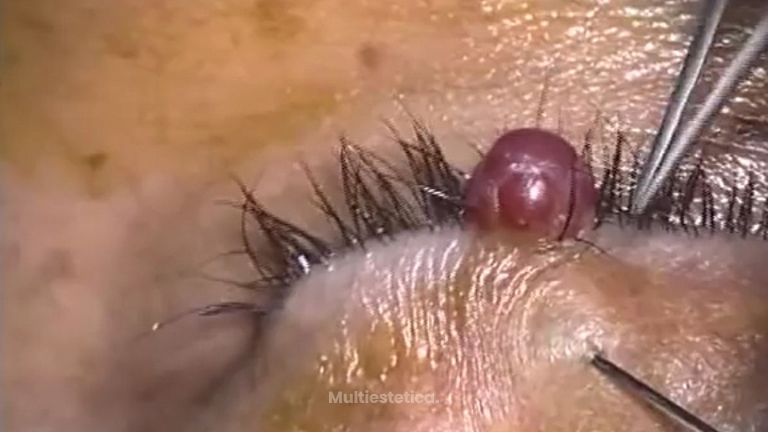 La forma más efectiva de eliminar un tumor palpebral