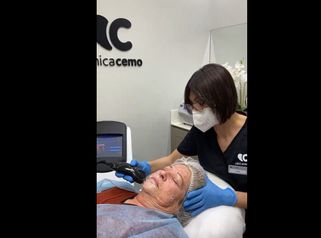 Radiofrecuencia facial - Clínica Cemo