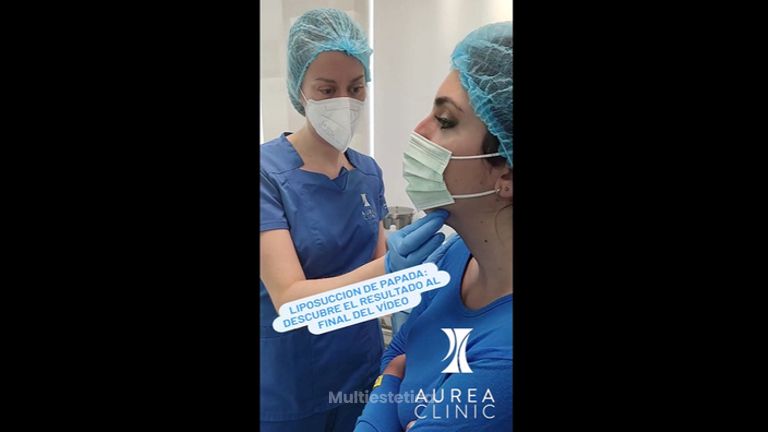 Liposucción de papada - Dra. Ana Martinez Padilla