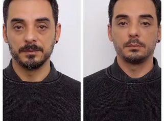 Clínica Carlos Gómez - Ácido hialurónico