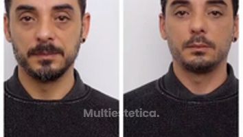 Clínica Carlos Gómez - Ácido hialurónico